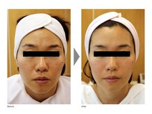 ベルフェム/リフトアップ小顔BSコース