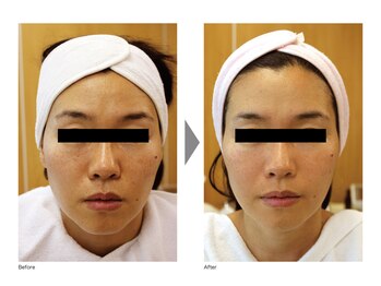 ベルフェム/リフトアップ小顔BSコース