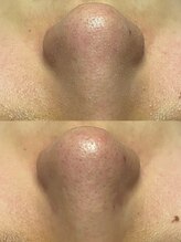 メディカルエステサロン ローズ 鯖江店(ROSE)/ツルツル毛穴へ導く！