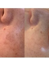 シェリモ(CHERIMO)/VOSサロンケア　ホワイト　7回