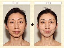 エクレクティック(ECLECTIC)/ハーブピーリング/小顔