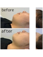 アリスビューティプラス(Alice Beauty+)/光フェイシャルでリフトUP☆