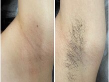 サロン ラズリ 久留米店(SALON Lazuli)/【わき脱毛】脱毛デビューに◎