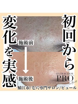 ピュール 鯖江店(PUR)/毛穴サロン/毛穴ケア/毛穴洗浄