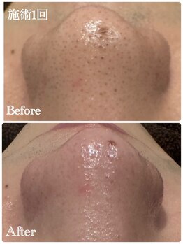 グラサヴォーグ 金沢店/見た目の肌変化に驚き♪