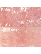 ミニョスキンラボ/韓国式ハーブピーリング6回