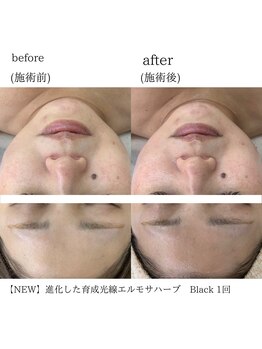 ケイリー(kaylee)/ハーブピーリング