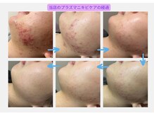 小顔×肌質ケア&経絡ヒーリングKimusubi /ニキビケアの経過をわかりやすく