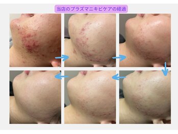 小顔×肌質ケア&経絡ヒーリングKimusubi /ニキビケアの経過をわかりやすく