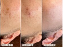 プライベートアイラッシュサロン ヴィレージュ 稲毛店(Vireijou)の雰囲気（本気のシミケアで｢隠すメイク｣を卒業。鏡を見るのが楽しみに！）