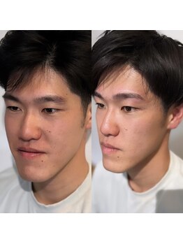 ハービー 高岳店(HARVEY)/お客様施術例