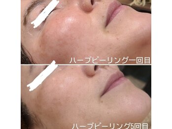 シス(SiS.)/ハーブピーリング5回目☆