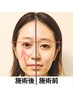 【クイック小顔】左右差、フェイスラインが劇的変化、横顔美人 13,200円⇒