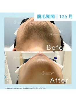 メンズクリア 柏店/【メンズクリア】お客様の施術例