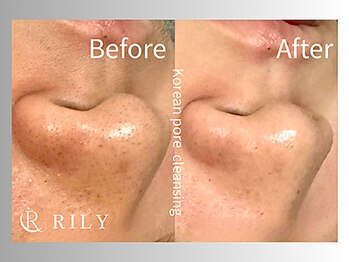 リリー(RILY)/【毛穴洗浄ビフォーアフター】