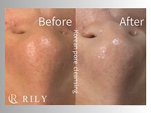 リリー(RILY)/【毛穴洗浄ビフォーアフター】