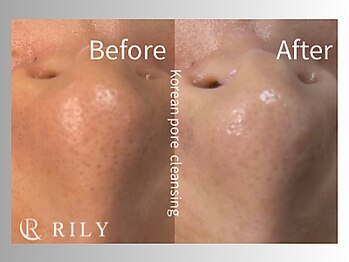 リリー(RILY)/【毛穴洗浄ビフォーアフター】