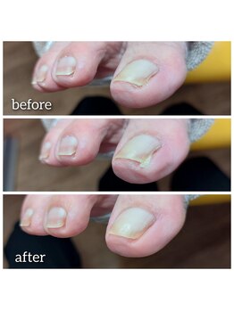 爪切り屋 足楽/【巻き爪痛】