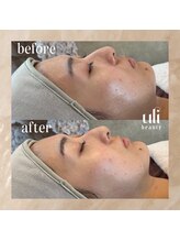 ウリ(uli beauty)/比較写真