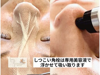クリアホワイト(Clear White)/気になる鼻周りもスッキリ☆