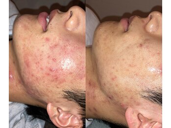 ブブオム 恵比寿本店(BUB OMME)/アクアダーマ