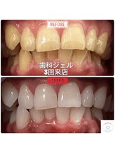 グロウ 東区香椎(GLOW)/本格ホワイトニング