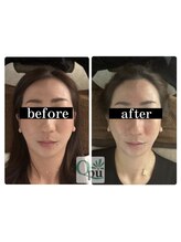 キュープ 小倉店(Qpu) 人気No3 美顔器