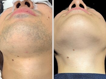 ビクトリー(VICTORY)/メンズ　ヒゲ脱毛