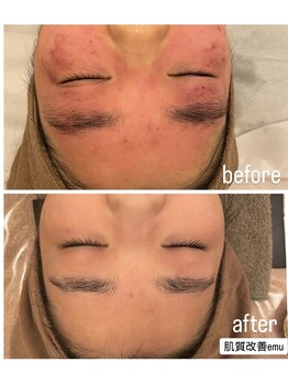 エミュ(emu)/ハーブケア　お客様before/after