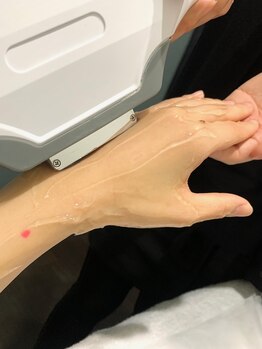 ハーニーズ(HARNEYS)/【腕脱毛】照射