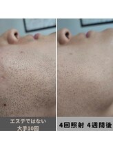 キムラケ 和光別邸(木村家 KIMURAKE)/他社比較　メンズ脱毛ヒゲ