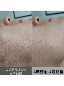 キムラケ 和光別邸(木村家 KIMURAKE)/他社比較　メンズ脱毛ヒゲ