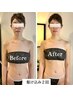 【１回で変わる！小顔矯正】"エラボト "なしで、輪郭をV字へ！輪郭縮小術！