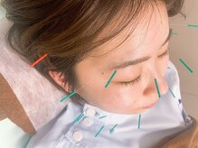 レメディ/美容鍼スペシャルコース