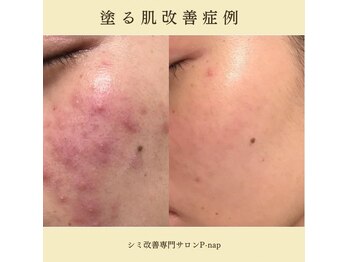 ピーナップ(P-nap)