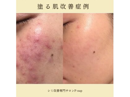 ピーナップ(P-nap)の写真