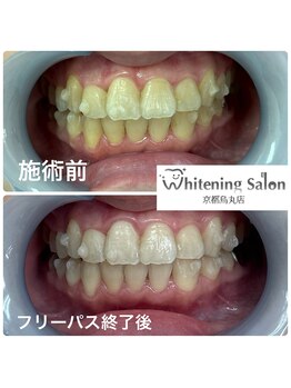 ホワイトニングサロン 京都烏丸店/ホワイトニング施術例