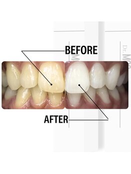 ルナベル(Luna Bell)/ホワイトニング