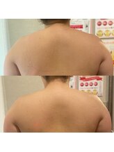 シュシュ(Chou chou)/痩身 Before＆After