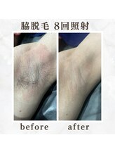 ボゴス(BOGOSS)/脇脱毛８回照射