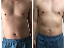 腰痛特化整体院 山本/30代男性　慢性腰痛