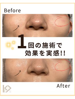 ケーナイン(K-9)/トリートメント施術1回の効果☆