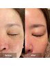 【しみケア】W水光肌ハーブピーリング（Ｗ成長因子美容液）※DTあり