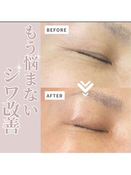 リラクゼーションサロン ラキ(laki)/ハイピールイントゥ/ピーリング