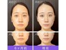 小顔スペシャル！大人気の光糸リフト＋小顔矯正 18900円→12900円