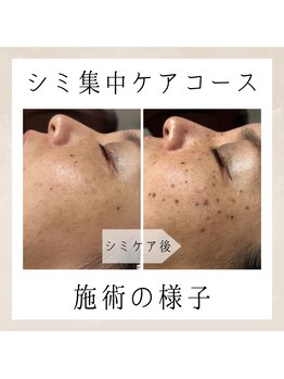 エンルーチェ(enluce)/【天六・梅田】シミケア