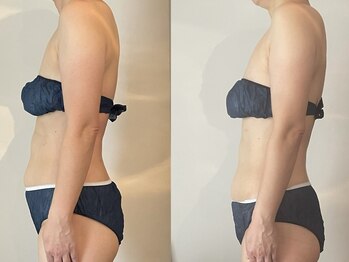 コンテ(Conte)/お腹の変化(遠赤痩身バンテージ)