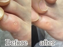 ポドロ(PoDoLo)/【小指の魚の目】