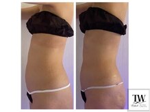 トワ 恵比寿(TOWA)/反り腰改善