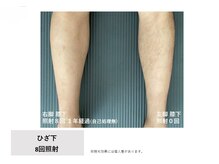 リブート(Re:Boot)の雰囲気（たった８回の照射でメンズのすね毛もここまで綺麗に）